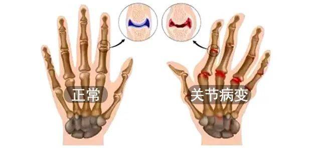 2, 原因二:骨关节炎引起 手指关节痛是骨关节炎最常见的一种症状表现