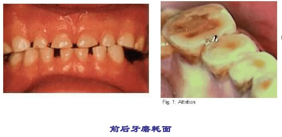 磨牙症的临床症状和治疗手段_咬合