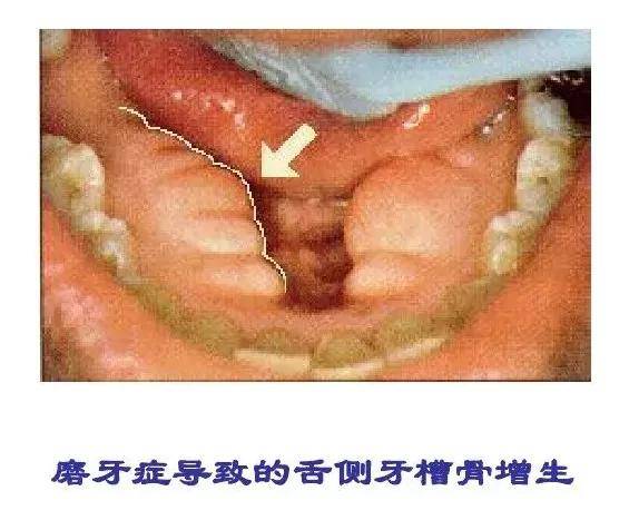 磨牙症的临床症状和治疗手段