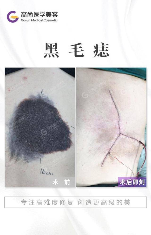 黑毛痣越长越大怎么破?治疗时机,你应该要知道
