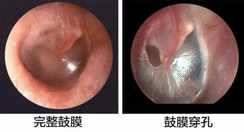 鼓膜穿孔的临床症状: 1,中耳炎患者的鼓膜穿孔,主要表现为反复流脓