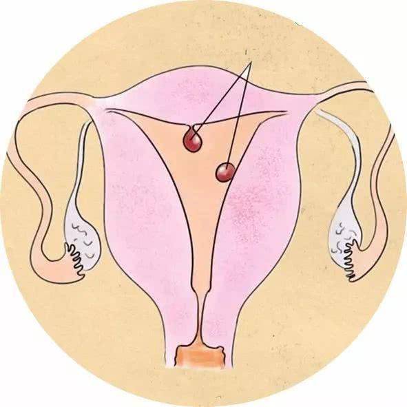 对于存在于子宫后壁,体积较大的子宫肌瘤,可能会因为压迫到直肠,导致