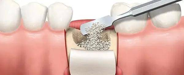 这时候就用到骨粉和骨膜,骨粉一般是术中填充在牙槽窝和缺失牙的部位