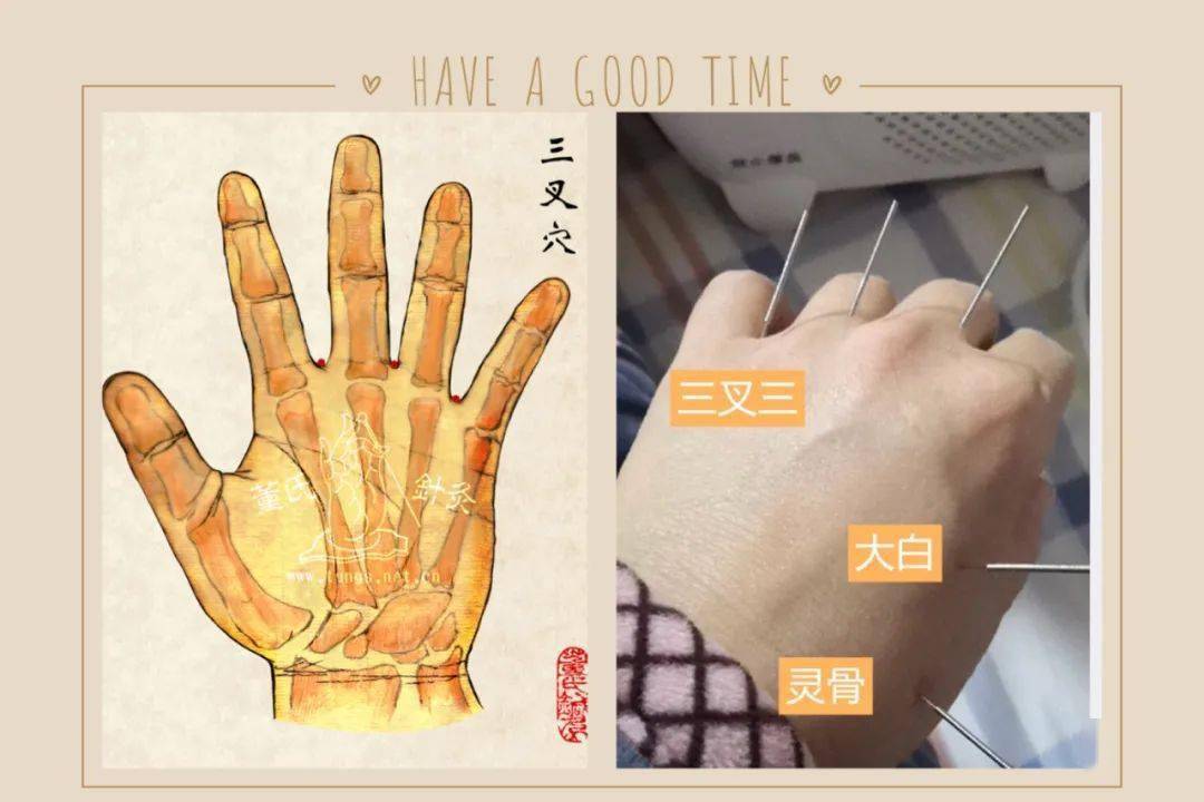 董氏针灸病症处方感冒