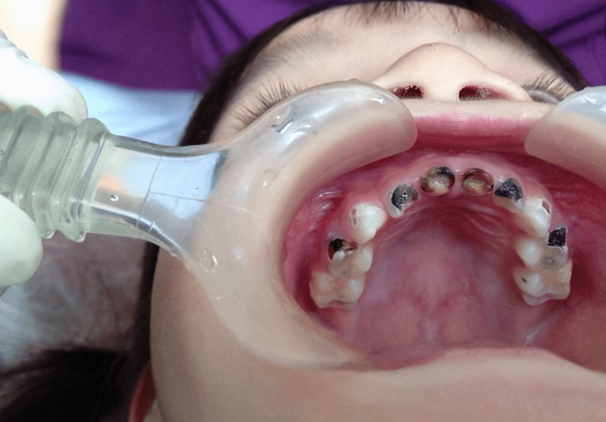 才6岁的小孩,几乎每颗牙都有不同大小的洞,有的牙齿甚至已经全部变黑