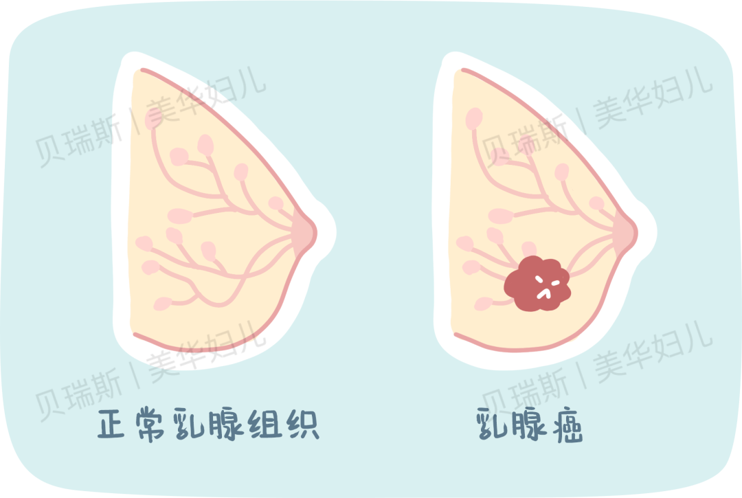 一张图教你乳房自检在家就能做乳腺问题早发现