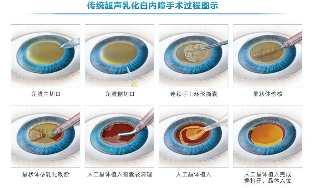 不用动刀就能做白内障手术?