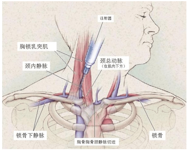 颈内静脉穿刺术