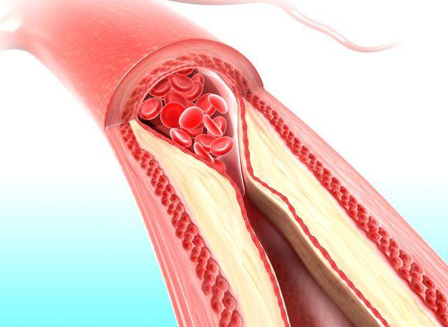 胆固醇高,血管堵塞,会造成那些危害?危害1.