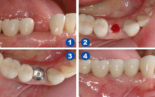 大连齿医生口腔种植牙的优势在哪里7个理由让你选择种植牙