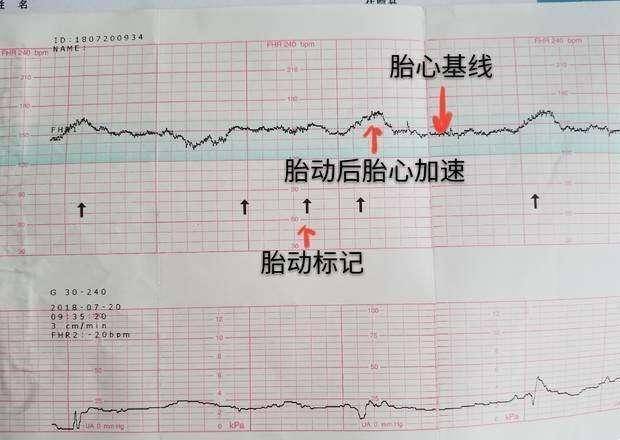 20分钟的胎心监护,总是有孕妈过不了,掌握几个技巧轻松得10分