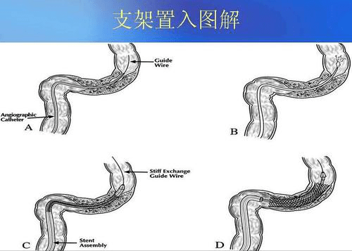 多学科协作,成功开展首例内镜下结肠支架置入术