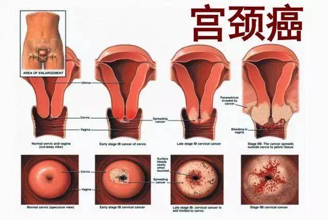 何禹赤珠分享:hpv感染致宫颈癌的易发人群有哪些?
