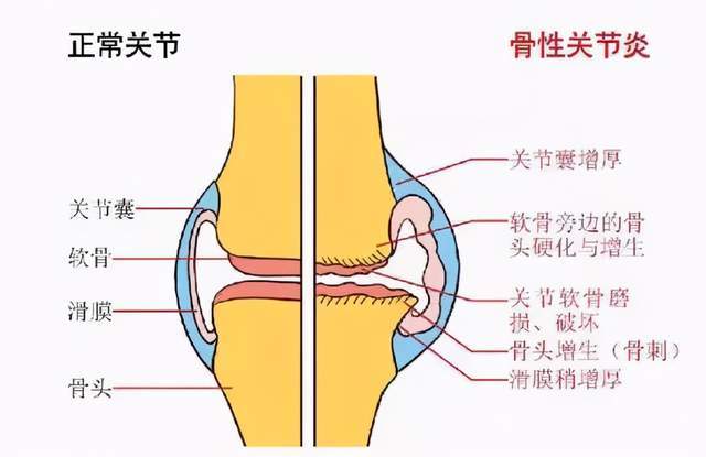 膝骨关节炎只能"换关节"?看看关节外科大夫如何"保膝"