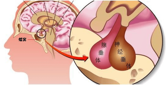 无诱因头痛,视力下降,警惕垂体瘤!