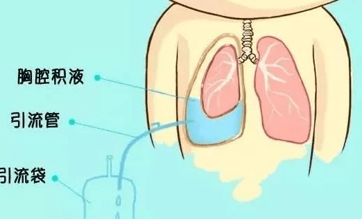 应对靶向药副作用:白血病【胸腔积液】怎么办?