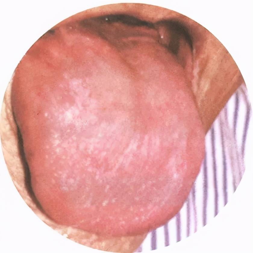 舌色:暗红色 舌苔:薄腻苔 舌面:湿润 这种舌象多为正气亏虚,中焦运化