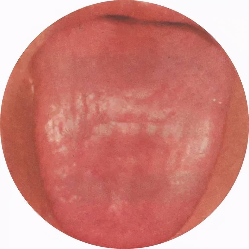 瘦红舌大多是由于肝肾阴虚,瘀毒内蕴形成的.