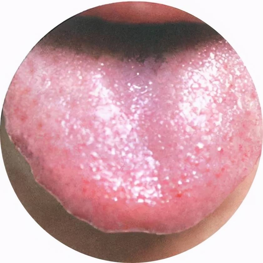 舌苔:薄,黄腻 舌质:暗红 舌体:有齿痕 此舌象患者或有胃腹胀痛,嗳气