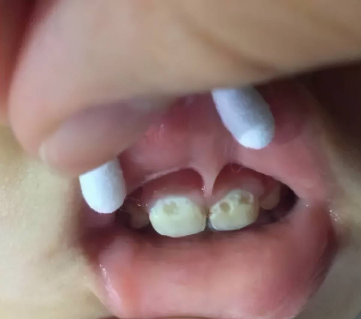 07乳牙牙缝大,换牙后会有改善吗? 正常来说,会的.