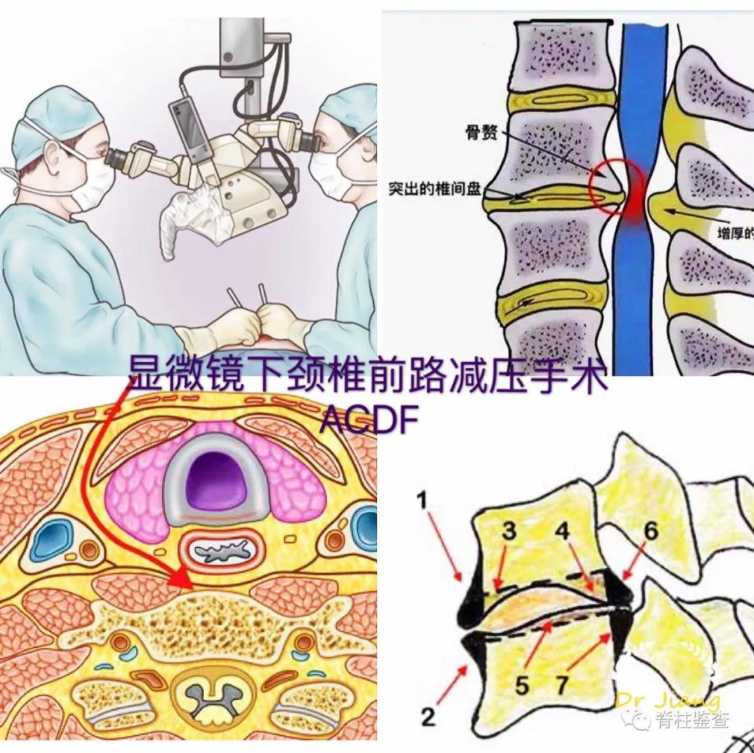 无骨折脱位型颈脊髓损伤 显微镜下减压安全有效