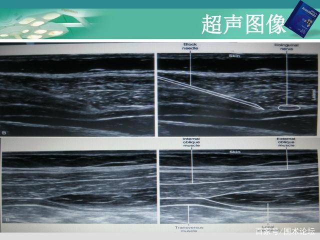 超声引导下腹横肌平面神经阻滞(tap)