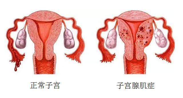 广药三院肿瘤一科分享不死的癌症 : 子宫腺肌症.