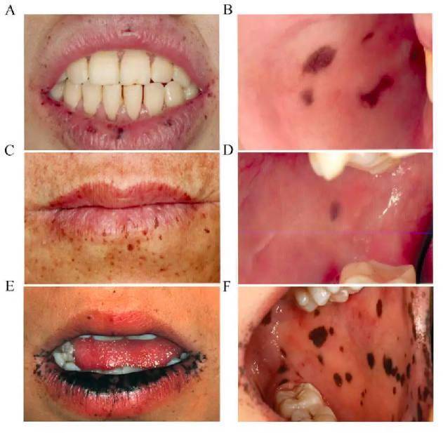 惠州20岁小伙口腔,手脚出现点点黑斑,原是这个"罕见病"的征兆