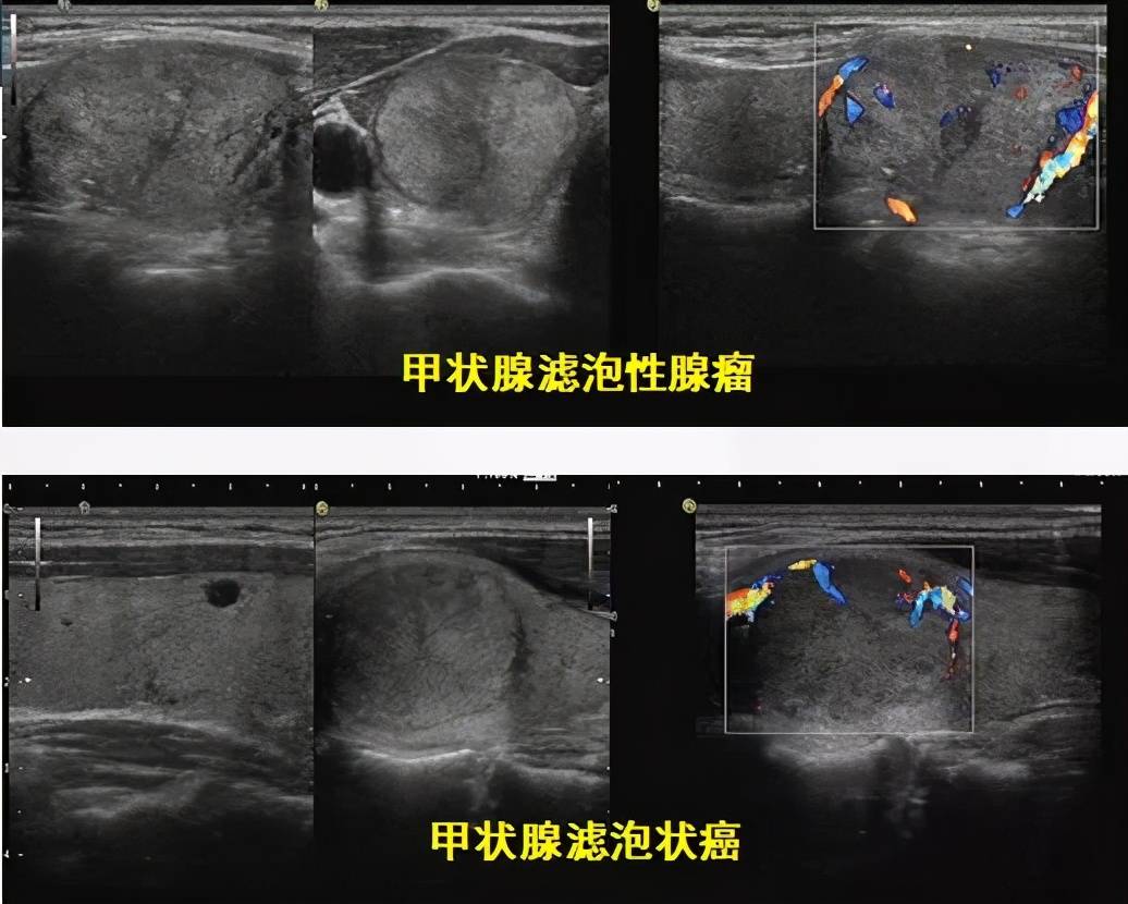 解读甲状腺滤泡状癌的相关困惑问题