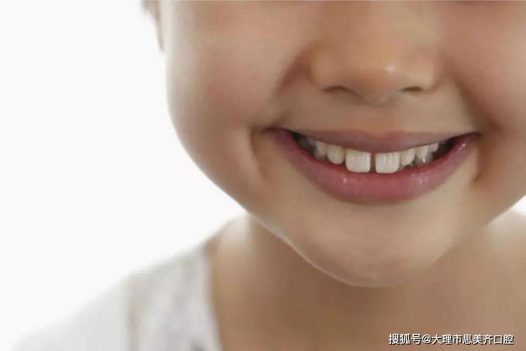 换完牙后,孩子的门牙竟成了"大板牙"!