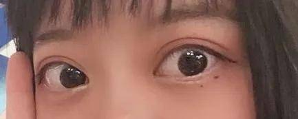 我的甲亢变成了甲减,这是怎么回事?