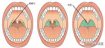 如果你能看到扁桃体,但是没有超过腭咽弓,那么属于一度肿大,就是下图