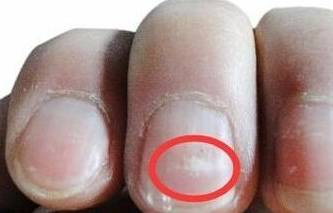 手指甲上有竖纹 指甲出现5种情况都是大病来临的前兆