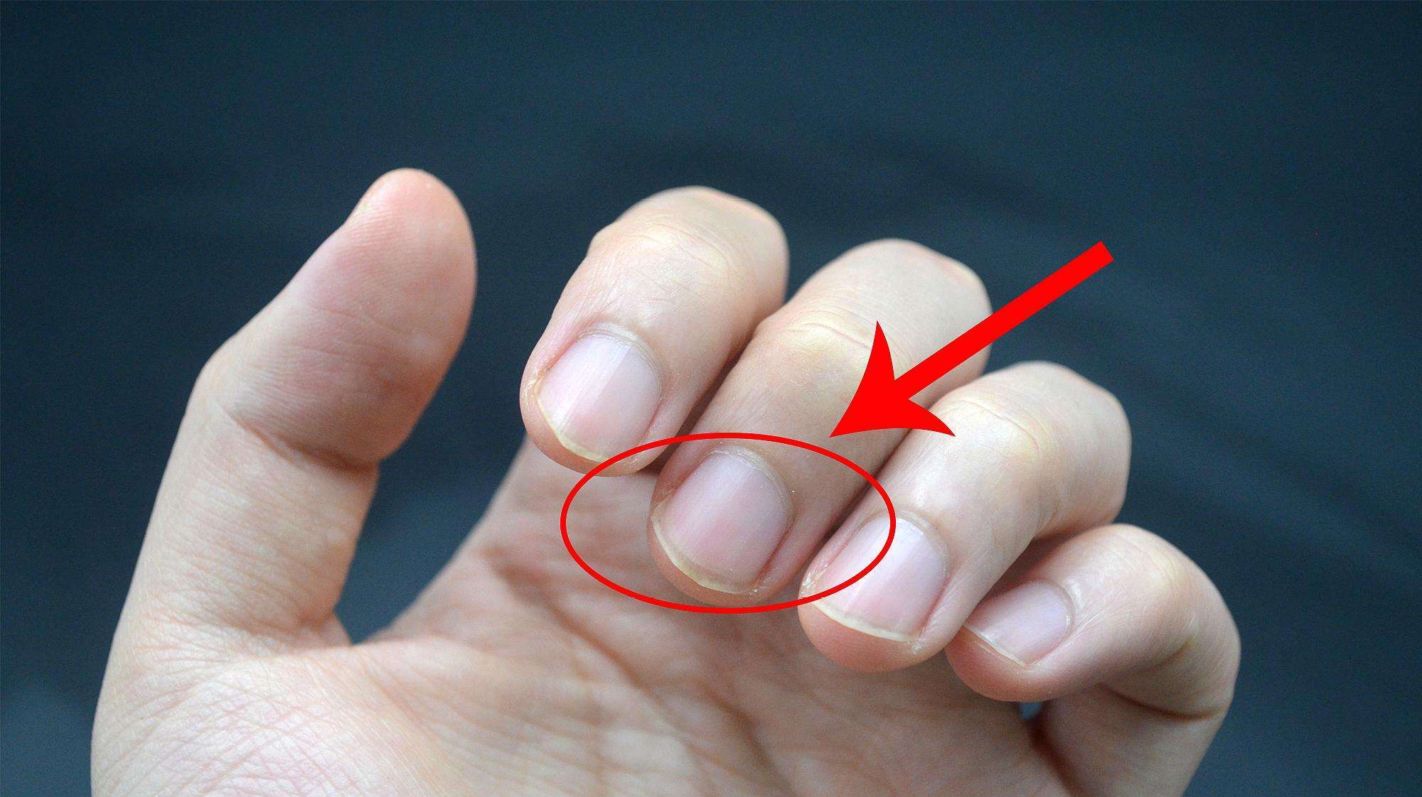 指甲看不到月牙,横纹多,指甲两侧有倒刺,暗示哪些健康