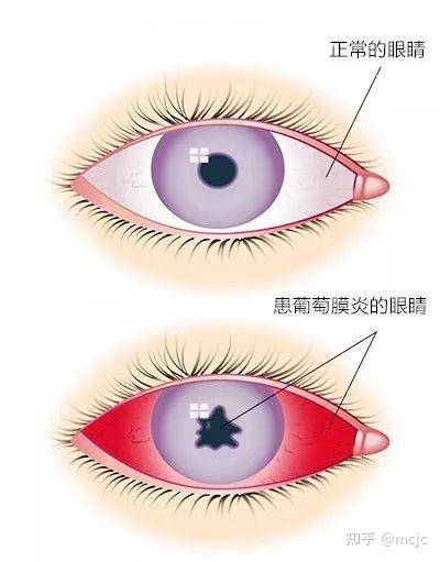 2.葡萄膜炎巩膜炎比葡萄膜炎痛苦小,并且不会产生视力模糊或光敏性.