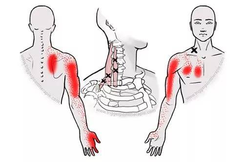斜角肌激发的上背部疼痛几乎总是被错误地认为是由菱形肌引起.