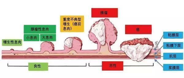 肠内癌变,大便先知?大便若有4种"异常",建议早做肠癌检查