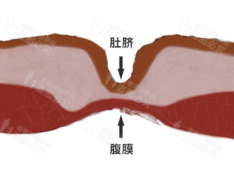 肚脐眼里面到底有多脏?