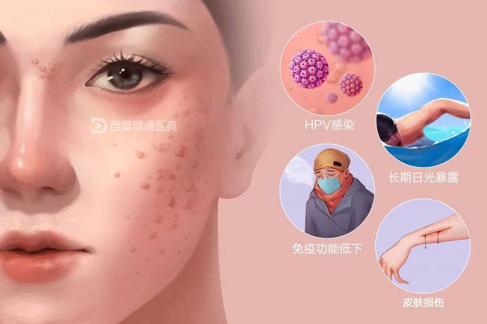 在临床型hpv感染中自行消退率较高,少数患者可复发,治疗上以外用药物