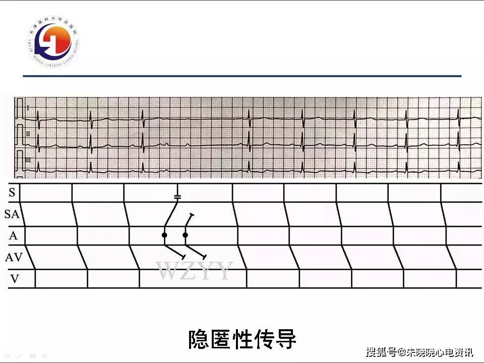 梯形图在疑难心电图诊断中的应用