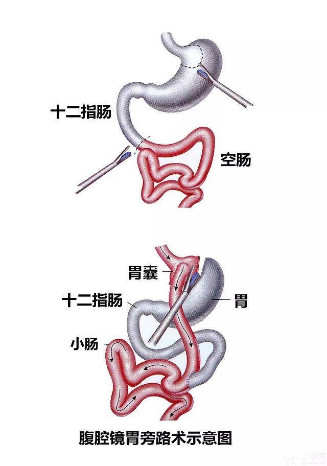 大胃王们还在纠结怎样减重吗不妨试试这一方法