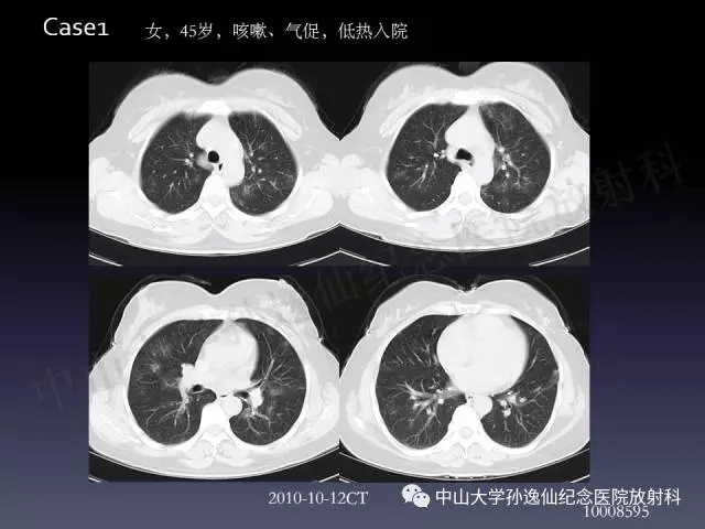 肺出血的影像学特征