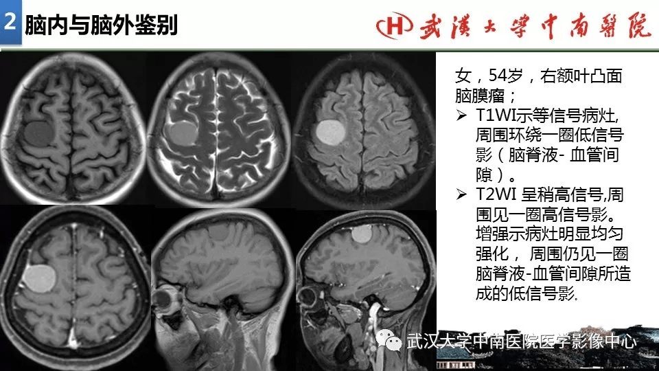 局灶性脑部病变影像诊断思路