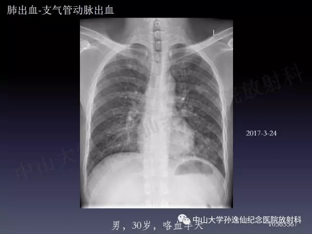 肺出血的影像学特征