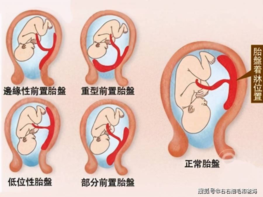 原创怀孕时,胎盘前壁,后壁有什么不一样?真的能看出性别吗?