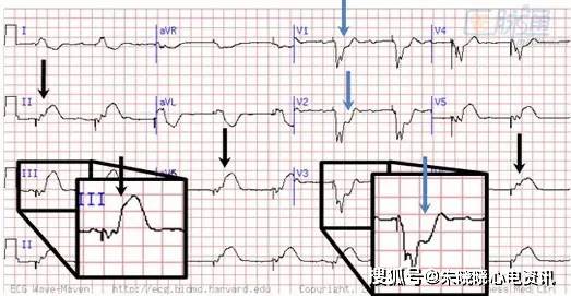 心肌梗死:这些线索你可能错过了_心电图
