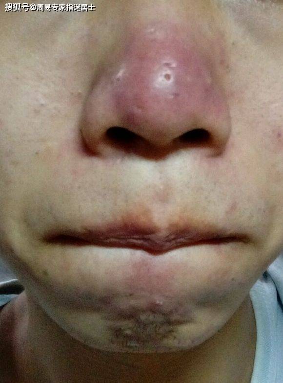 酒糟鼻面相运势解析