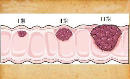 排便出现这4"症状",可能和肠癌有关,需当心_大便