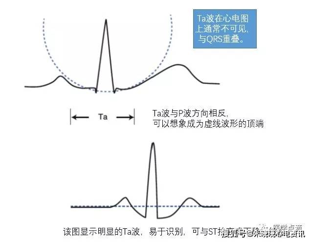 心电图"零"基础入门,干货满满!