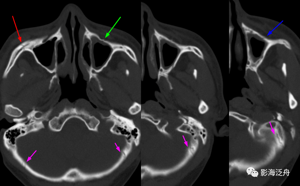 连续层面的第三层左侧上颌窦前壁又显示一透亮线影(蓝箭),这个是骨折